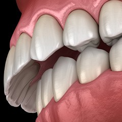 Illustration of overbite