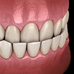 Illustration of an underbite