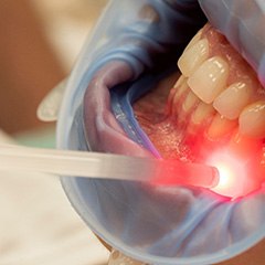 The benefits of laser periodontal treatment include more comfortable and precise care