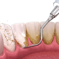 Illustration of scaling and root planing on backs of teeth