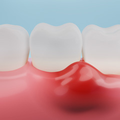 Illustration of teeth and inflamed gums