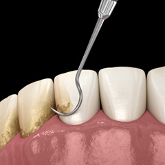 Illustration of scaling and root planing performed on front side of lower teeth